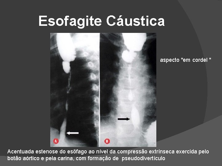 Esofagite Cáustica aspecto "em cordel " Acentuada estenose do esôfago ao nível da compressão Esofagite Cáustica aspecto "em cordel " Acentuada estenose do esôfago ao nível da compressão