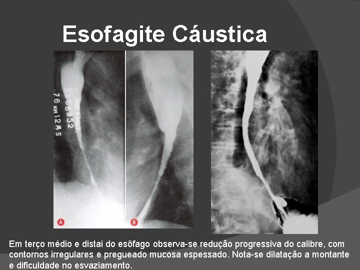 Esofagite Cáustica Em terço médio e distai do esôfago observa-se redução progressiva do calibre, Esofagite Cáustica Em terço médio e distai do esôfago observa-se redução progressiva do calibre,