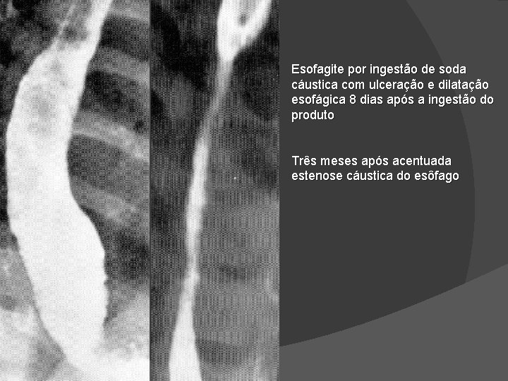 Esofagite por ingestão de soda cáustica com ulceração e dilatação esofágica 8 dias após Esofagite por ingestão de soda cáustica com ulceração e dilatação esofágica 8 dias após