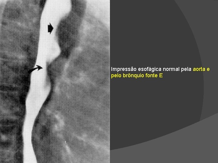 Impressão esofágica normal pela aorta e pelo brônquio fonte E Impressão esofágica normal pela aorta e pelo brônquio fonte E