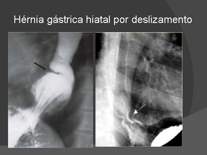 Hérnia gástrica hiatal por deslizamento Hérnia gástrica hiatal por deslizamento