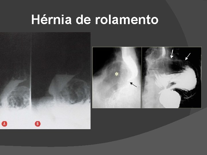 Hérnia de rolamento Hérnia de rolamento