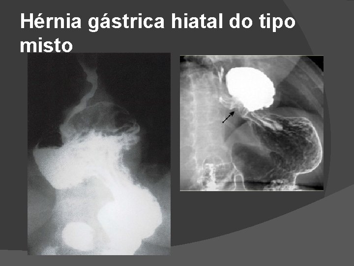 Hérnia gástrica hiatal do tipo misto Hérnia gástrica hiatal do tipo misto