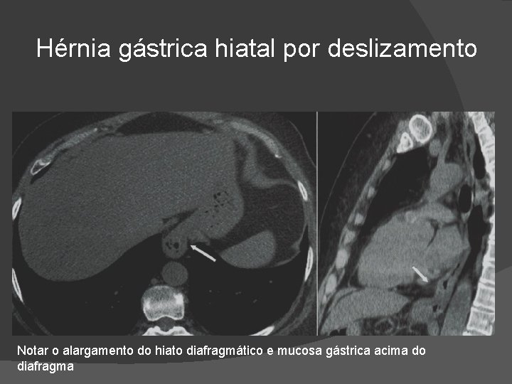 Hérnia gástrica hiatal por deslizamento Notar o alargamento do hiato diafragmático e mucosa gástrica Hérnia gástrica hiatal por deslizamento Notar o alargamento do hiato diafragmático e mucosa gástrica
