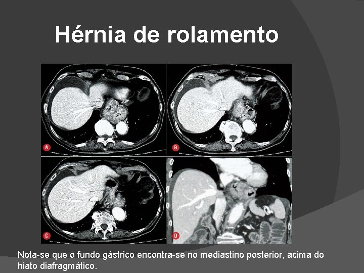 Hérnia de rolamento Nota-se que o fundo gástrico encontra-se no mediastino posterior, acima do Hérnia de rolamento Nota-se que o fundo gástrico encontra-se no mediastino posterior, acima do