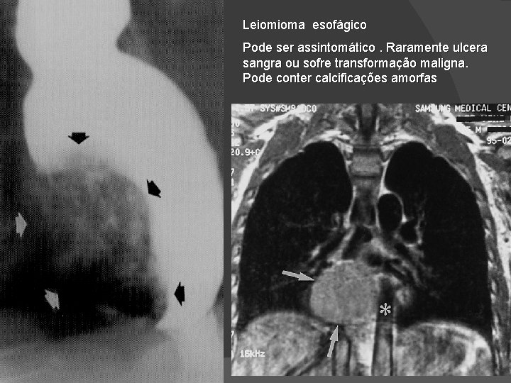 Leiomioma esofágico Pode ser assintomático. Raramente ulcera sangra ou sofre transformação maligna. Pode conter Leiomioma esofágico Pode ser assintomático. Raramente ulcera sangra ou sofre transformação maligna. Pode conter