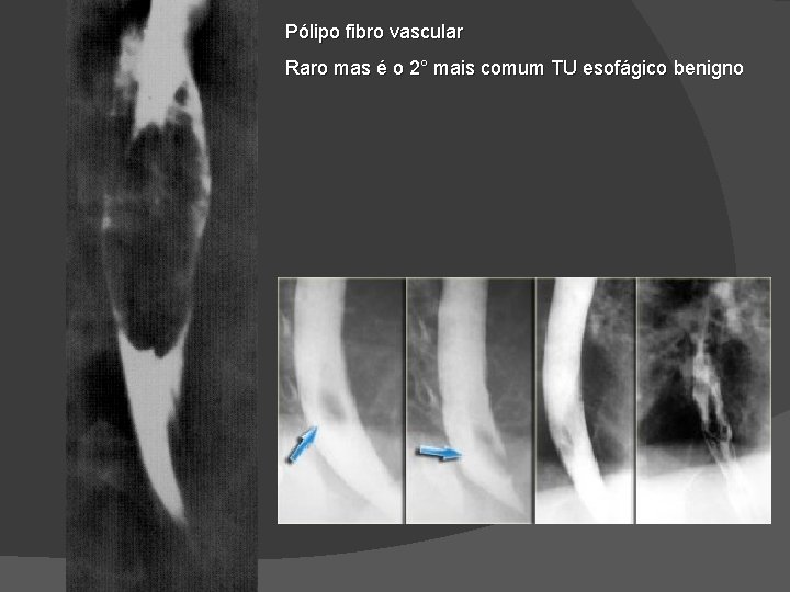 Pólipo fibro vascular Raro mas é o 2° mais comum TU esofágico benigno Pólipo fibro vascular Raro mas é o 2° mais comum TU esofágico benigno