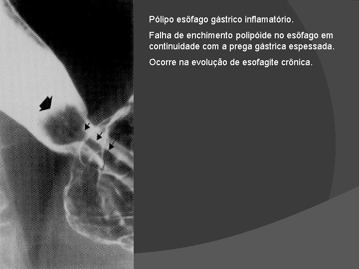 Pólipo esôfago gástrico inflamatório. Falha de enchimento polipóide no esôfago em continuidade com a Pólipo esôfago gástrico inflamatório. Falha de enchimento polipóide no esôfago em continuidade com a