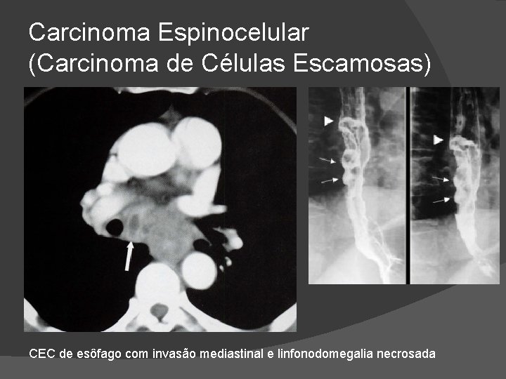 Carcinoma Espinocelular (Carcinoma de Células Escamosas) CEC de esôfago com invasão mediastinal e linfonodomegalia Carcinoma Espinocelular (Carcinoma de Células Escamosas) CEC de esôfago com invasão mediastinal e linfonodomegalia