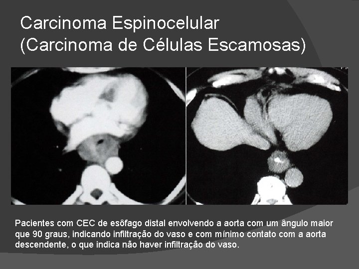 Carcinoma Espinocelular (Carcinoma de Células Escamosas) Pacientes com CEC de esôfago distal envolvendo a Carcinoma Espinocelular (Carcinoma de Células Escamosas) Pacientes com CEC de esôfago distal envolvendo a