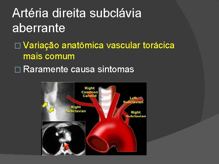 Artéria direita subclávia aberrante � Variação anatômica vascular torácica mais comum � Raramente causa Artéria direita subclávia aberrante � Variação anatômica vascular torácica mais comum � Raramente causa