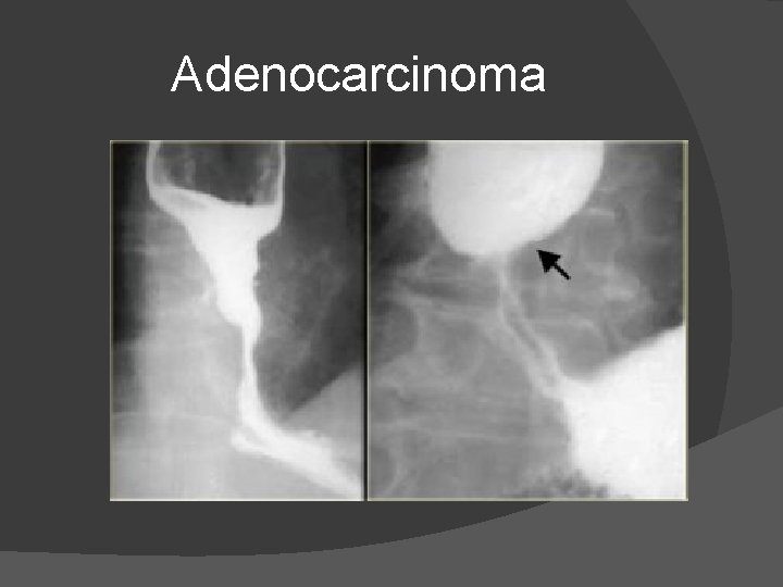 Adenocarcinoma Adenocarcinoma
