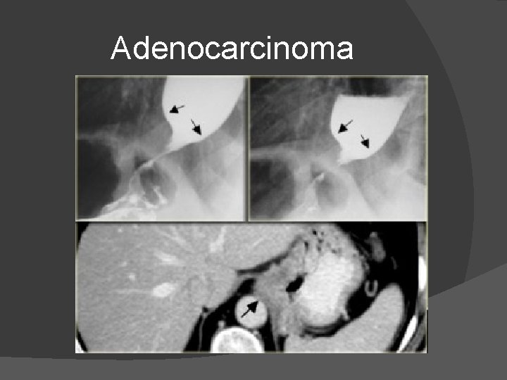 Adenocarcinoma Adenocarcinoma