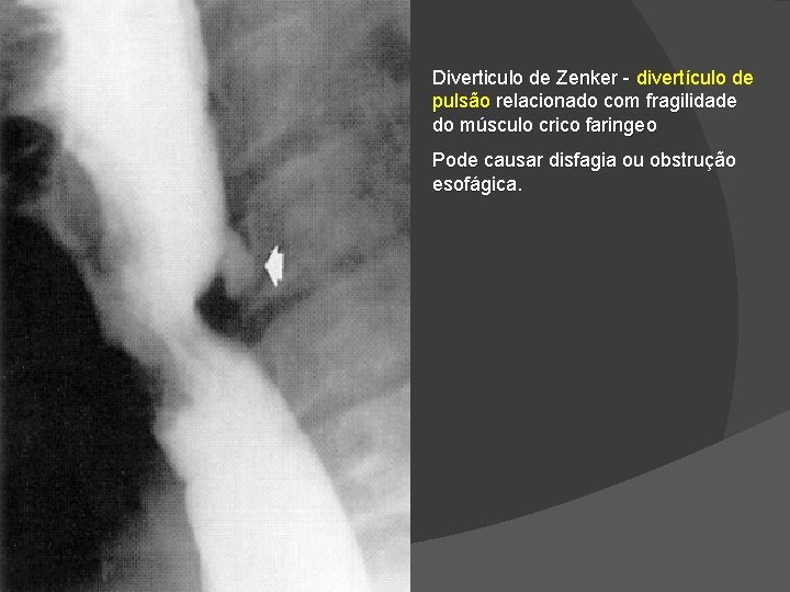Diverticulo de Zenker - divertículo de pulsão relacionado com fragilidade do músculo crico faringeo Diverticulo de Zenker - divertículo de pulsão relacionado com fragilidade do músculo crico faringeo