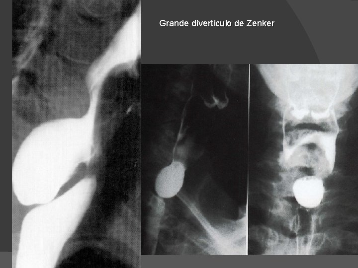 Grande divertículo de Zenker Grande divertículo de Zenker