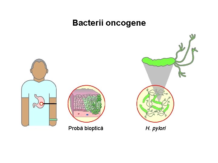 Bacterii oncogene Probă bioptică H. pylori 