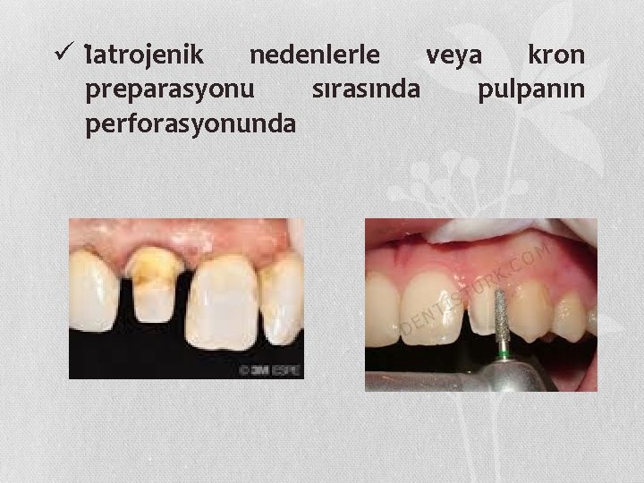 ü I atrojenik nedenlerle veya kron preparasyonu sırasında pulpanın perforasyonunda 