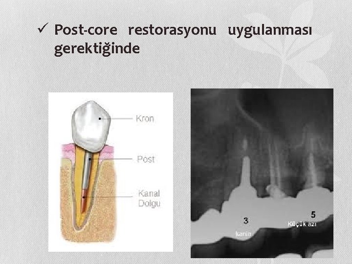 ü Post-core restorasyonu uygulanması gerektig inde 