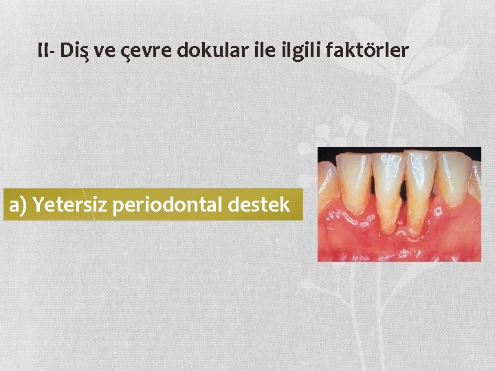 II- Dis ve c evre dokular ile ilgili fakto rler a) Yetersiz periodontal destek