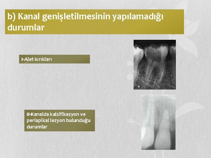 b) Kanal genişletilmesinin yapılamadığı durumlar I-Alet kırıkları II-Kanalda kalsifikasyon ve periapikal lezyon bulunduğu durumlar