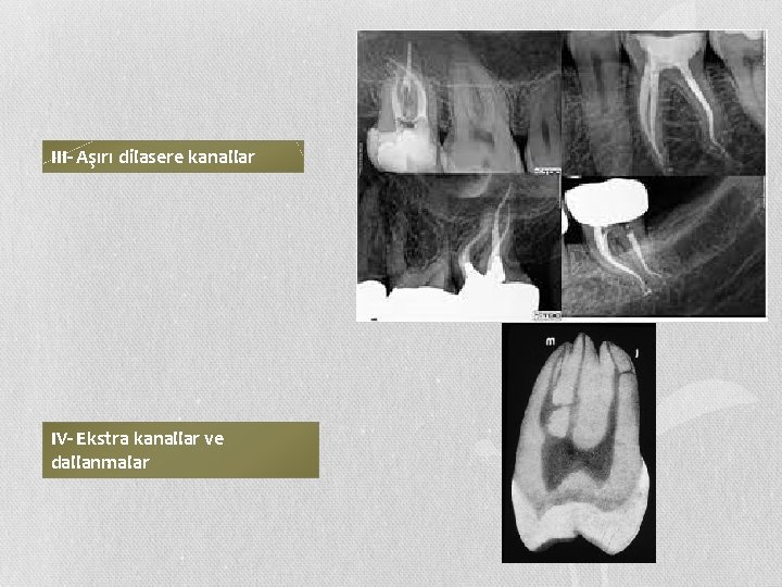 III- Aşırı dilasere kanallar IV- Ekstra kanallar ve dallanmalar 