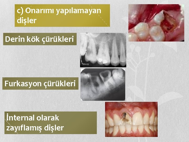 c) Onarımı yapılamayan dişler Derin kök çürükleri Furkasyon çürükleri İnternal olarak zayıflamış dişler 
