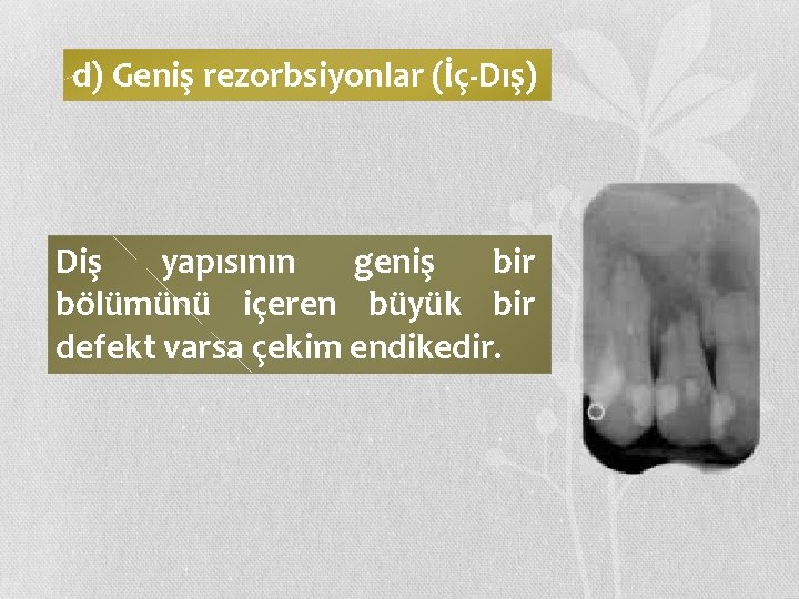 d) Geniş rezorbsiyonlar (İç-Dış) Diş yapısının geniş bir bölümünü içeren büyük bir defekt varsa