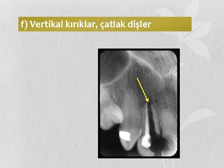f) Vertikal kırıklar, çatlak dişler 