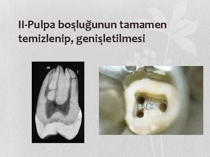 II-Pulpa bos lug unun tamamen temizlenip, genis letilmesi 