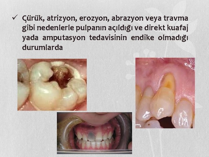 ü C u ru k, atrizyon, erozyon, abrazyon veya travma gibi nedenlerle pulpanın ac