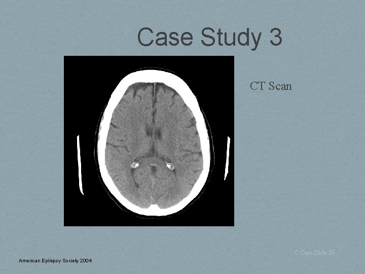 Case Study 3 CT Scan C Case-Slide 29 American Epilepsy Society 2004 
