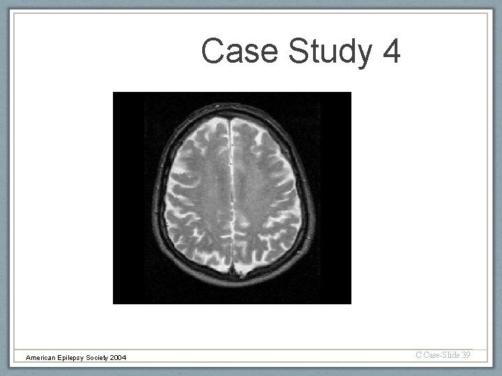 Case Study 4 American Epilepsy Society 2004 C Case-Slide 39 