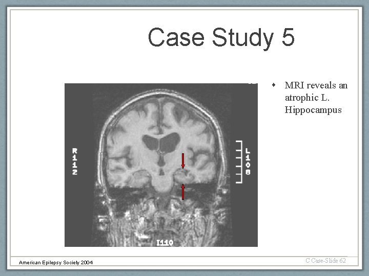 Case Study 5 MRI reveals an atrophic L. Hippocampus American Epilepsy Society 2004 C
