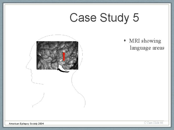 Case Study 5 MRI showing language areas American Epilepsy Society 2004 C Case-Slide 66