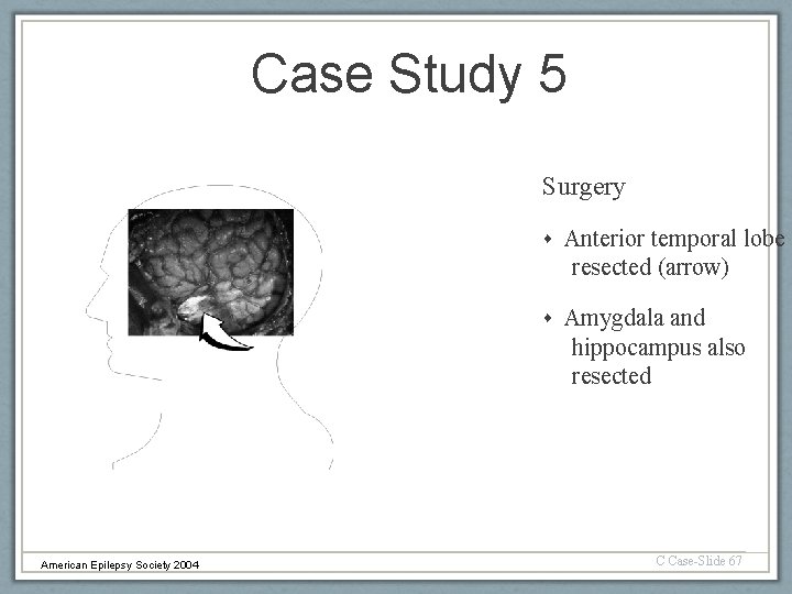 Case Study 5 Surgery Anterior temporal lobe resected (arrow) Amygdala and hippocampus also resected