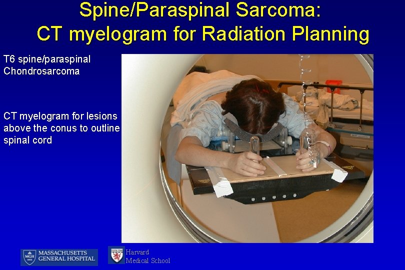 Spine/Paraspinal Sarcoma: CT myelogram for Radiation Planning T 6 spine/paraspinal Chondrosarcoma CT myelogram for