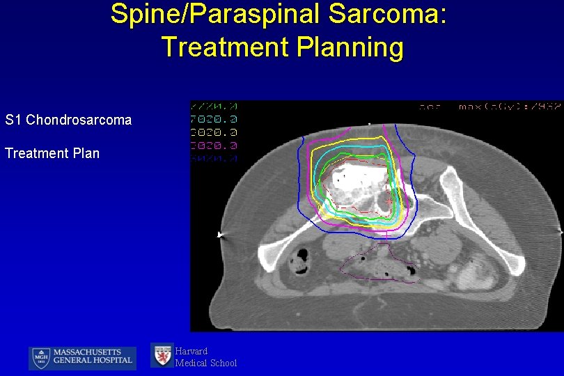 Spine/Paraspinal Sarcoma: Treatment Planning S 1 Chondrosarcoma Treatment Plan Harvard Medical School 