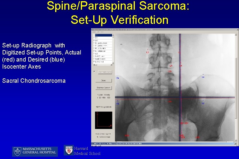 Spine/Paraspinal Sarcoma: Set-Up Verification Set-up Radiograph with Digitized Set-up Points, Actual (red) and Desired