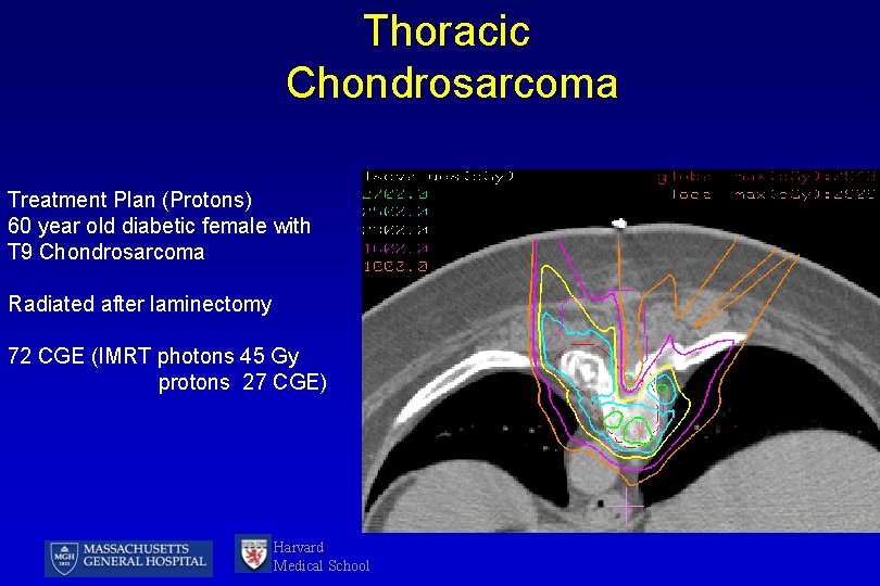 Thoracic Chondrosarcoma Treatment Plan (Protons) 60 year old diabetic female with T 9 Chondrosarcoma