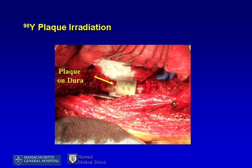 90 Y Plaque Irradiation Plaque on Dura Harvard Medical School 