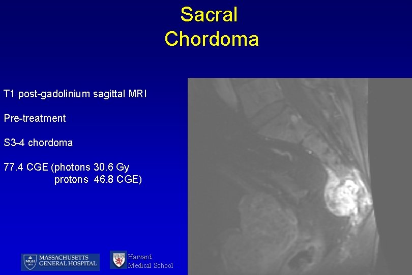 Sacral Chordoma T 1 post-gadolinium sagittal MRI Pre-treatment S 3 -4 chordoma 77. 4