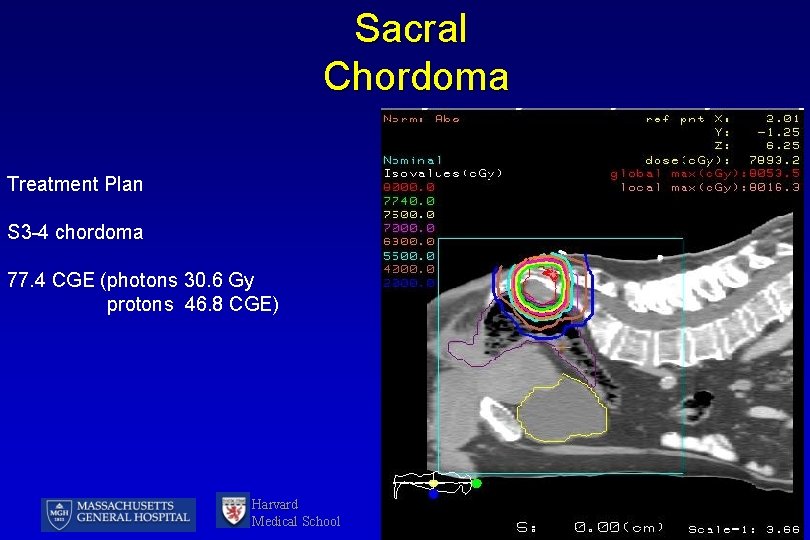 Sacral Chordoma Treatment Plan S 3 -4 chordoma 77. 4 CGE (photons 30. 6