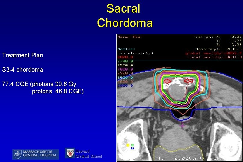 Sacral Chordoma Treatment Plan S 3 -4 chordoma 77. 4 CGE (photons 30. 6