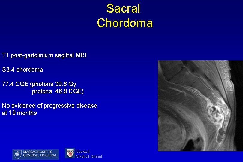 Sacral Chordoma T 1 post-gadolinium sagittal MRI S 3 -4 chordoma 77. 4 CGE