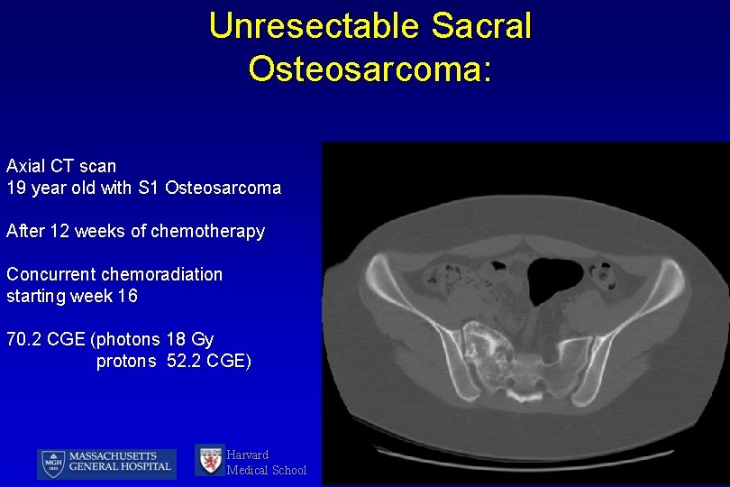 Unresectable Sacral Osteosarcoma: Axial CT scan 19 year old with S 1 Osteosarcoma After