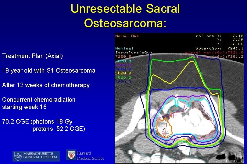 Unresectable Sacral Osteosarcoma: Treatment Plan (Axial) 19 year old with S 1 Osteosarcoma After