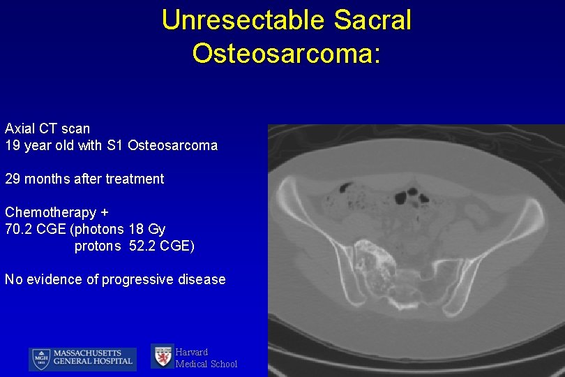 Unresectable Sacral Osteosarcoma: Axial CT scan 19 year old with S 1 Osteosarcoma 29