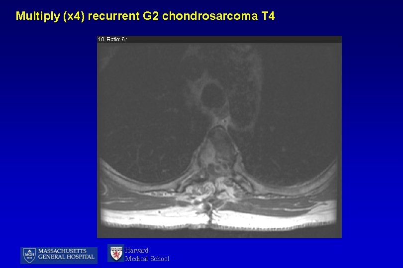 Multiply (x 4) recurrent G 2 chondrosarcoma T 4 Harvard Medical School 