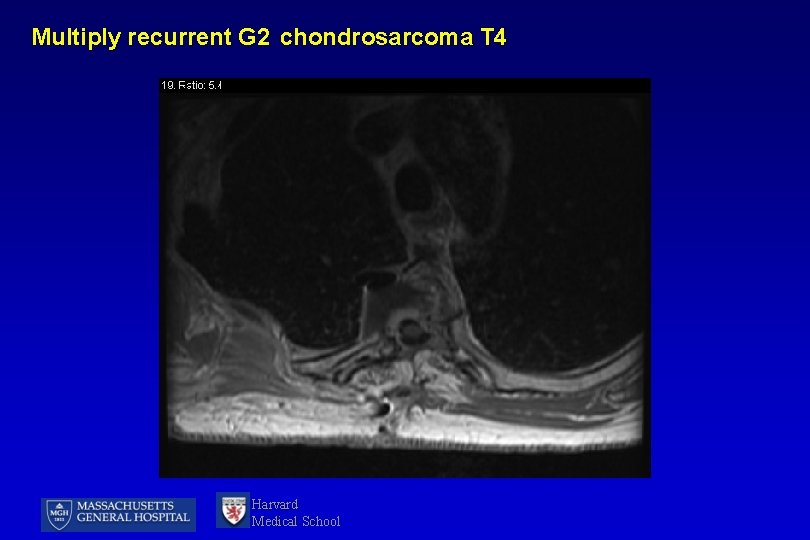 Multiply recurrent G 2 chondrosarcoma T 4 Harvard Medical School 