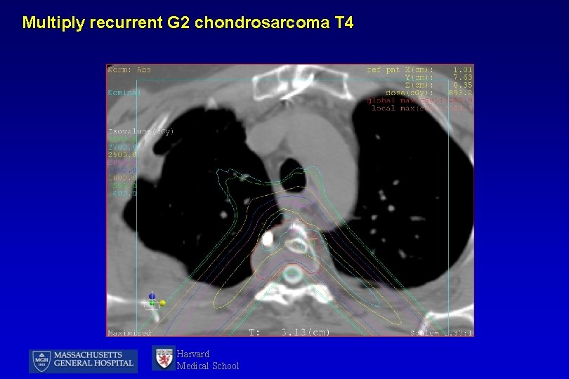 Multiply recurrent G 2 chondrosarcoma T 4 Harvard Medical School 